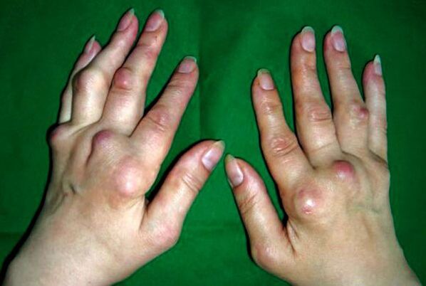 Hands affected by polyosteoarthritis deformans