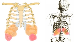 Back pain under the ribs symptoms.