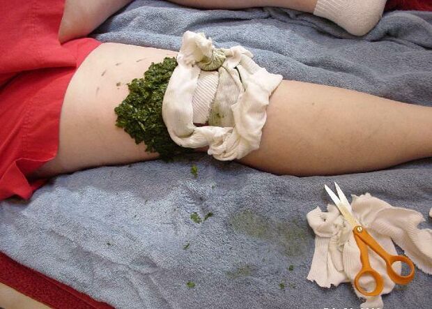 A warm compress of mashed cabbage leaves on a sore knee joint with osteoarthritis